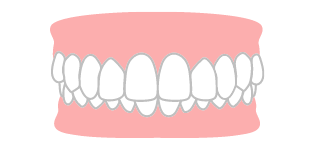 過蓋噛合のイラスト