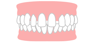 空隙歯列のイラスト