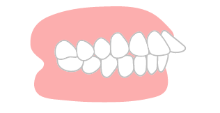 上顎前突のイラスト