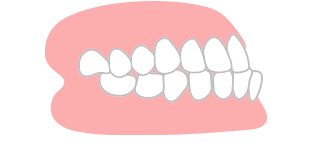 下顎前突のイラスト