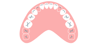 永久歯が生えてこないのイラスト